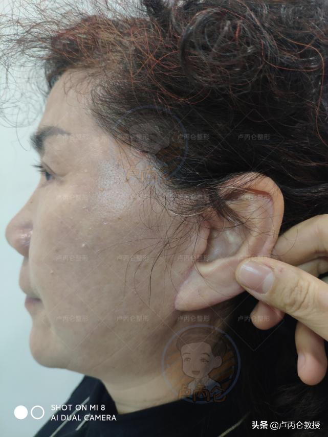 做拉皮除皱手术后遗症,拉皮除皱手术有哪些风险和后遗症