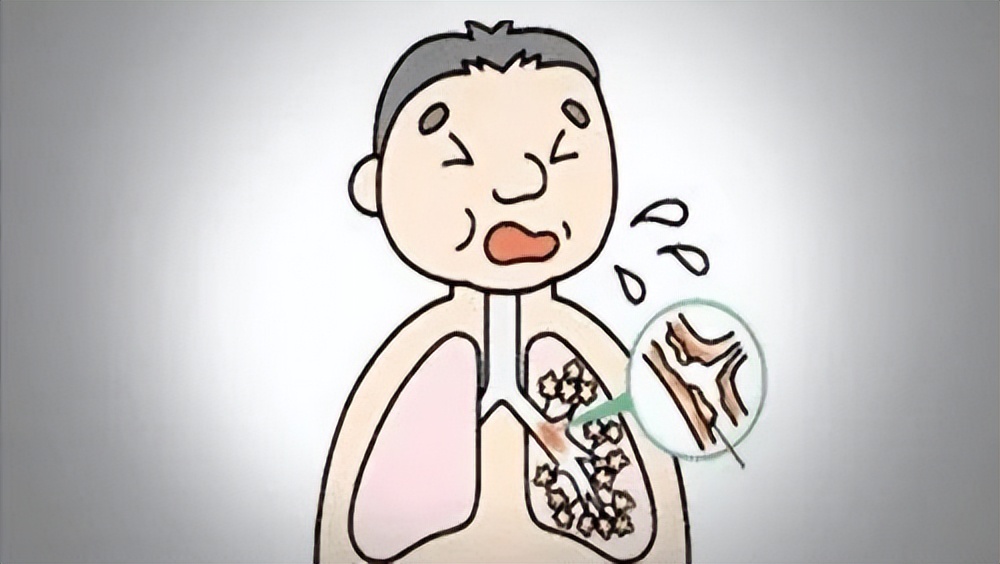 喉咙有痰咳不出小妙招,嗓子有痰咳不出怎么快速缓解