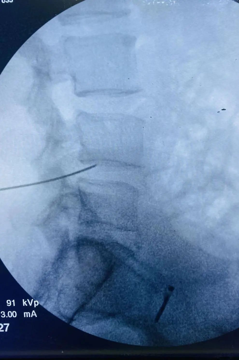 等离子脊柱微创手术,脊柱微创射频消融术