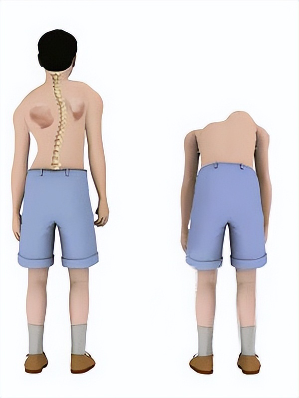 强直性脊柱炎和强直性脊柱炎,王主任强直性脊柱炎怎么治疗