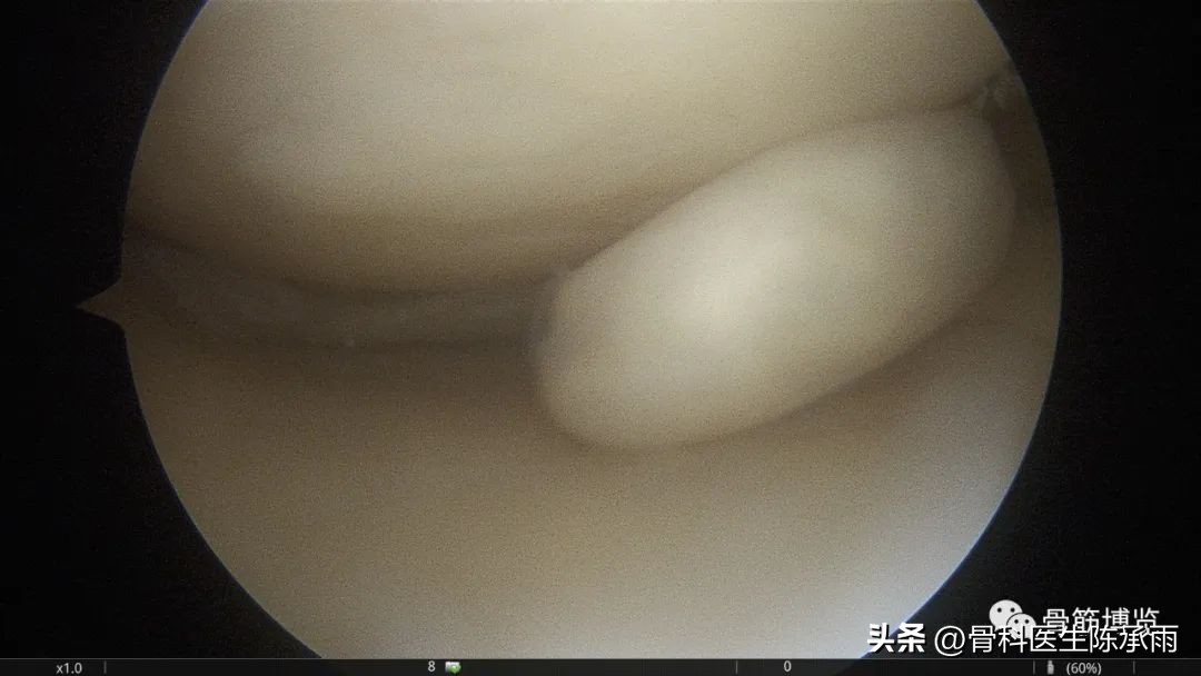 盘状半月板撕裂一级,半月板层裂愈合概率