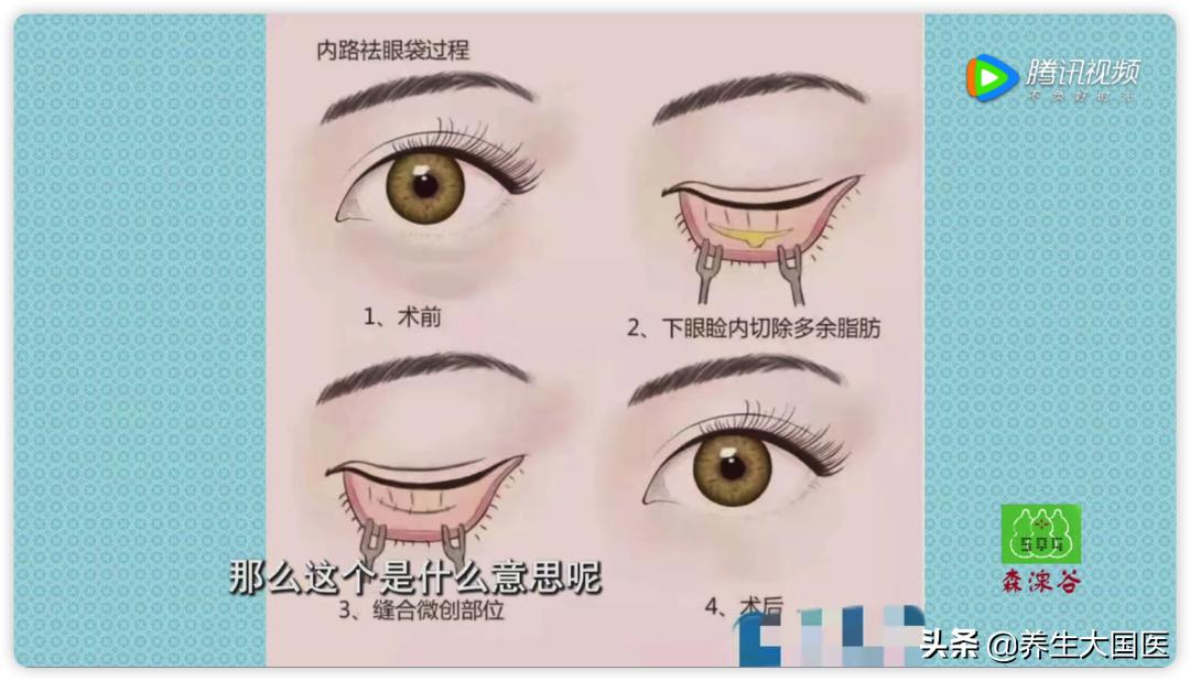 对付眼袋有良方,中年人的眼袋2分钟解决