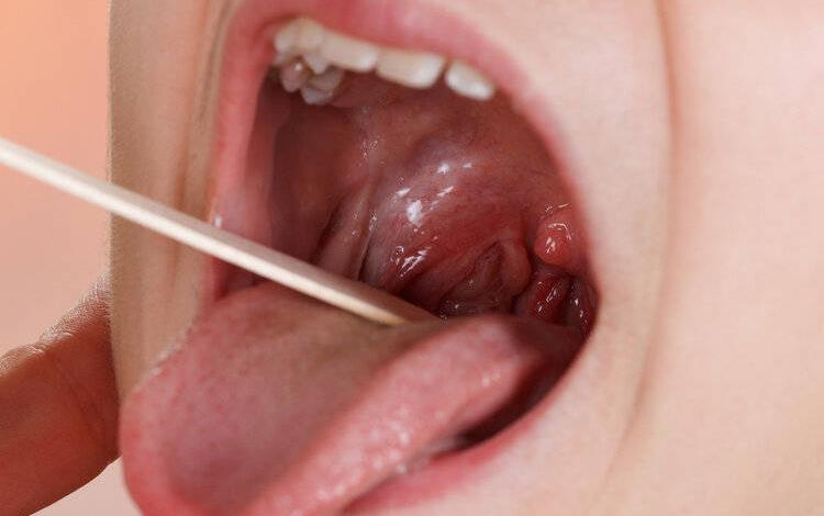 鱼刺卡喉咙你别再用这些土方法,鱼刺卡喉别吞米饭