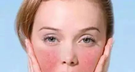 怎么修复脸部红血丝,怎么修复红血丝肌肤