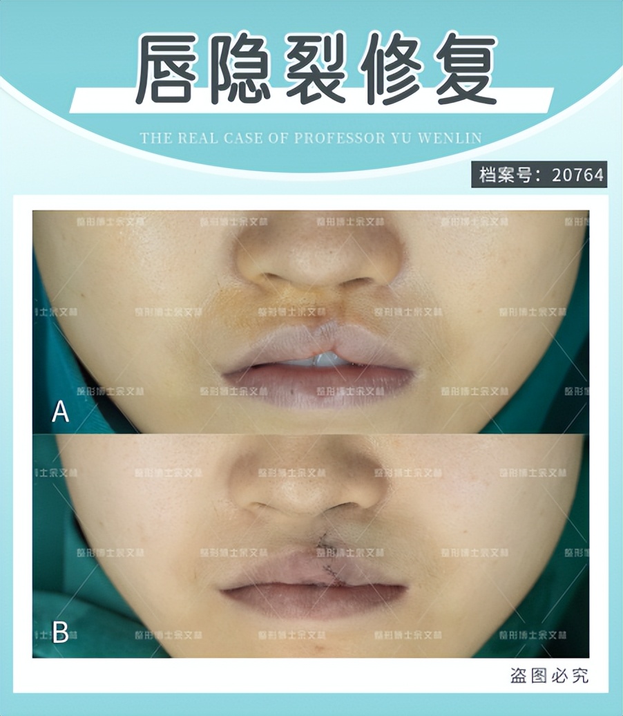 唇隐裂能完全修复吗,唇隐裂痕迹怎么消除