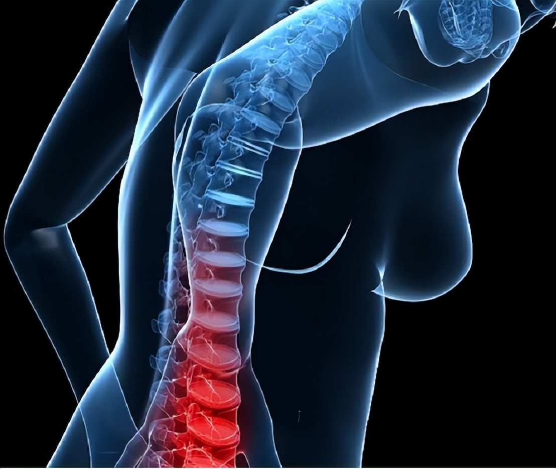女子腰椎间盘突出,女性腰痛和腰椎间盘突出