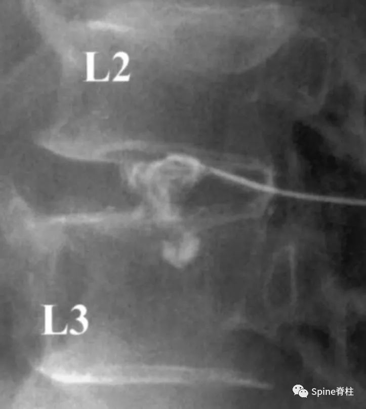 因腰椎问题导致的腰痛,慢性腰骶部疼痛