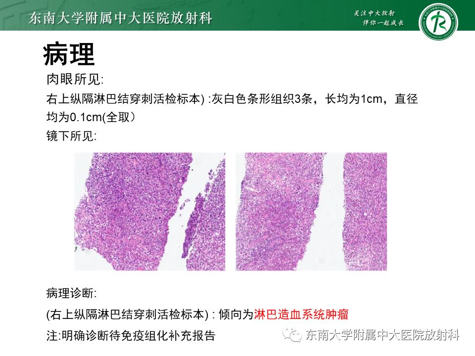 好文分享值得深思,纵隔精原细胞瘤