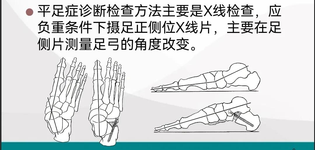 扁平足发病机制,扁平足诊断标准示意图