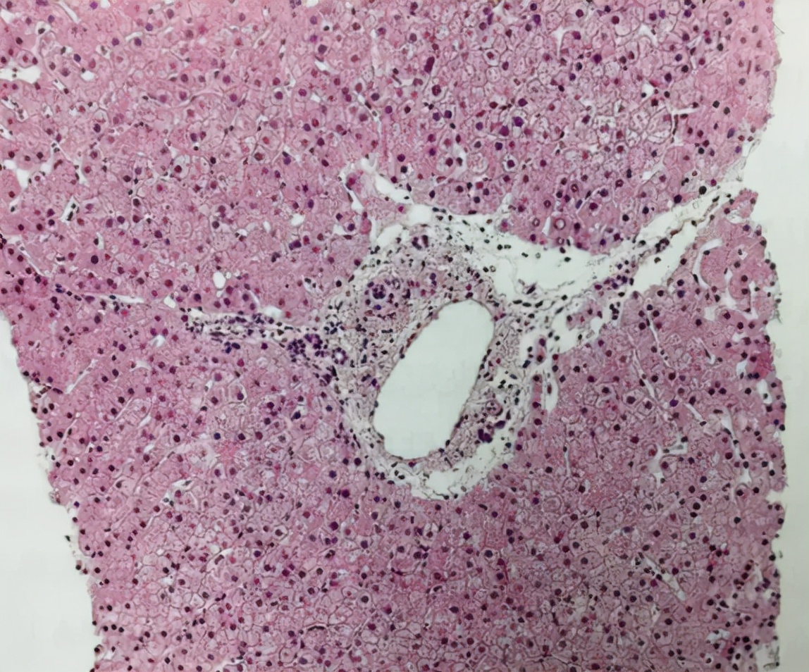 一文读懂丨自身免疫性肝炎该如何治疗?