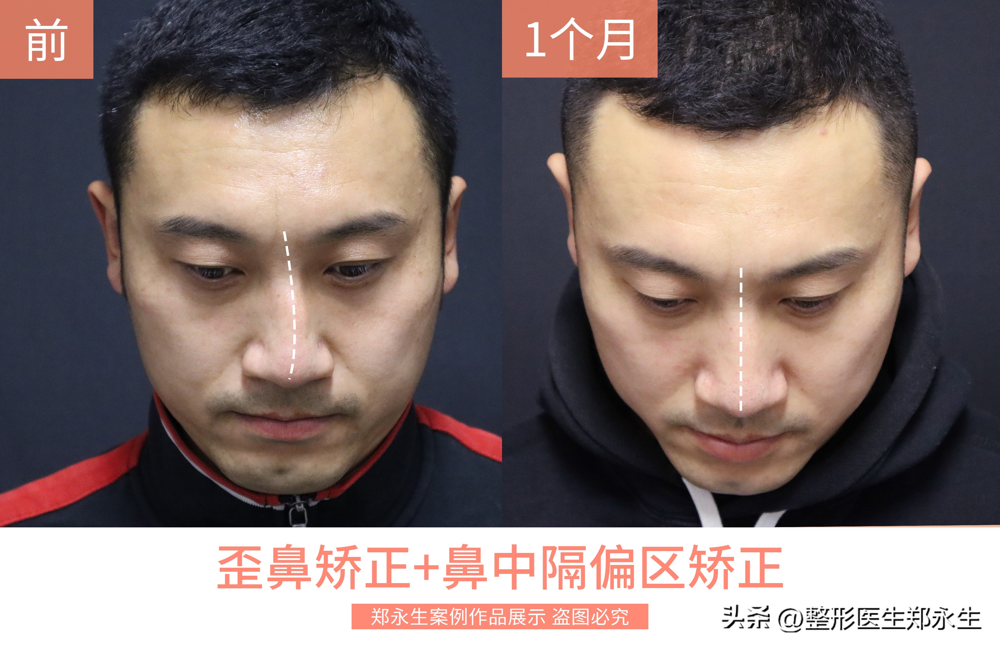 鼻中隔偏曲可以通过正骨矫正吗,鼻中隔偏曲矫正手术全过程真人