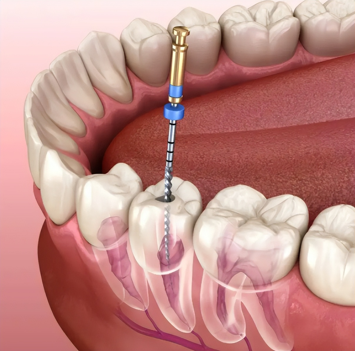 做了根管治疗的牙劈了怎么办,根管治疗以后牙劈了还能再补吗