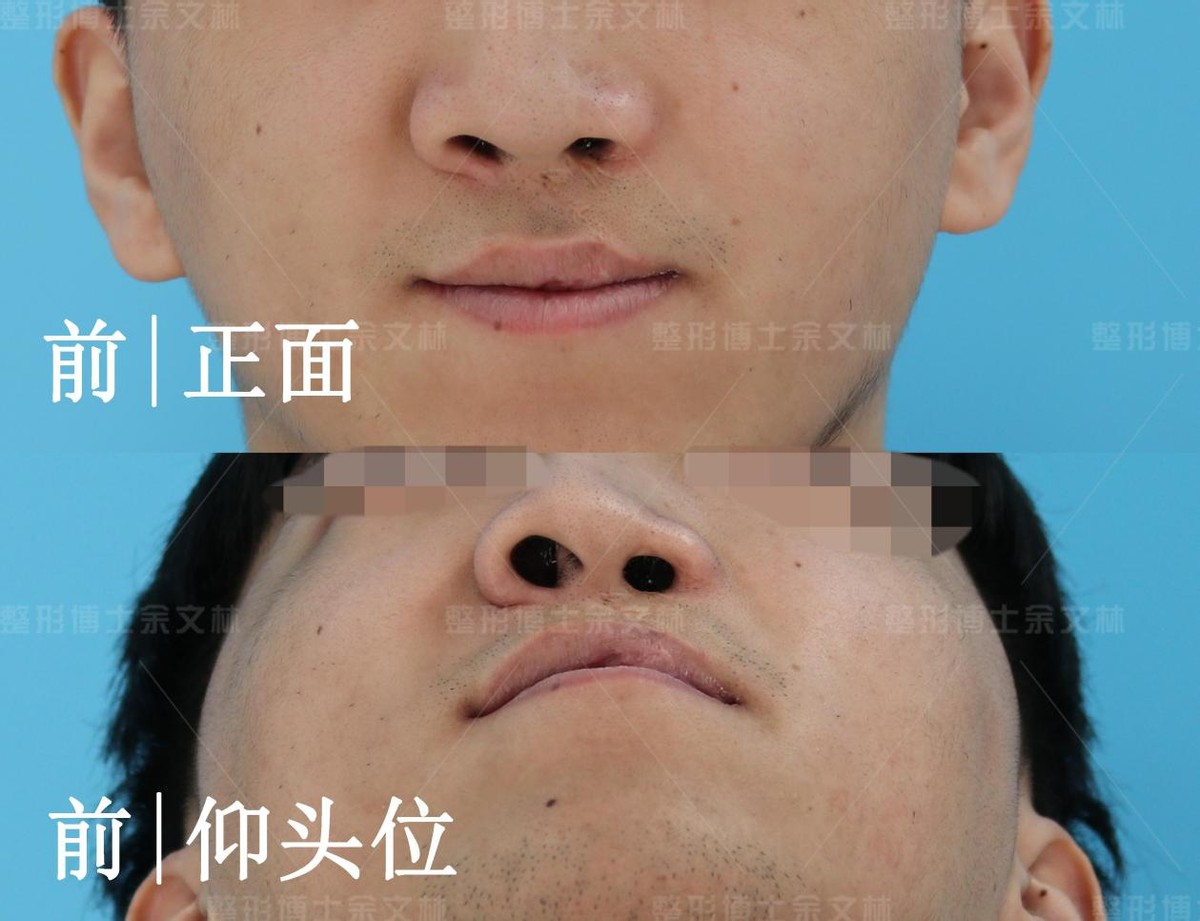 唇裂鼻畸形修复鼻子要多久才定型,唇腭裂鼻畸形怎么修复好