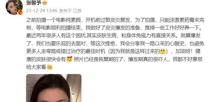 张馨予过敏皮炎第几期,张馨予皮肤过敏涂的什么