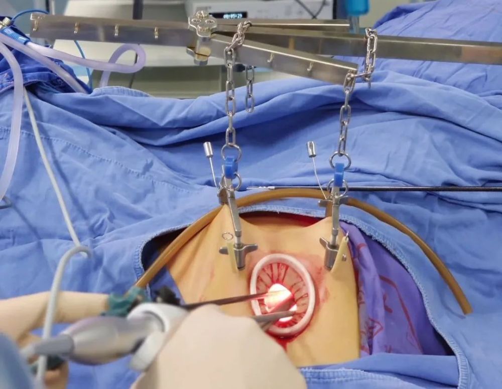 腹腔镜肾切除示意图,腹腔镜肾脏部分切除术