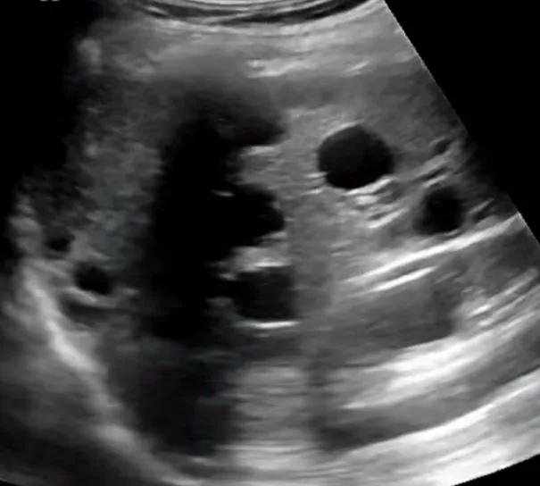 肝内血管瘤和肝癌超声怎么区分,肝占位病理检测项目