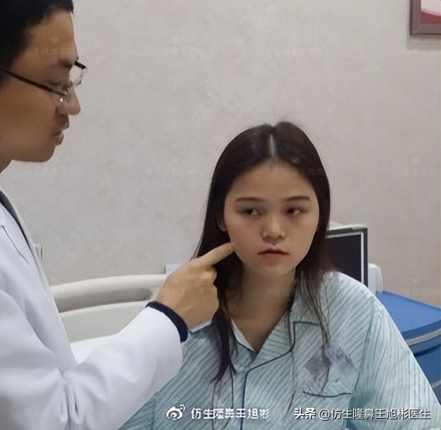 鼻整形最简易方法,鼻孔又大又塌又朝天鼻整形