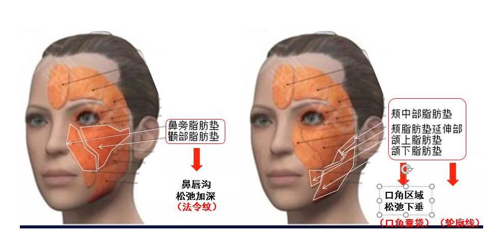 韦敏面部吸脂,九院韦敏植骨手术案例