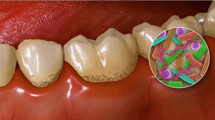 牙菌斑知多少,怎么去牙菌斑