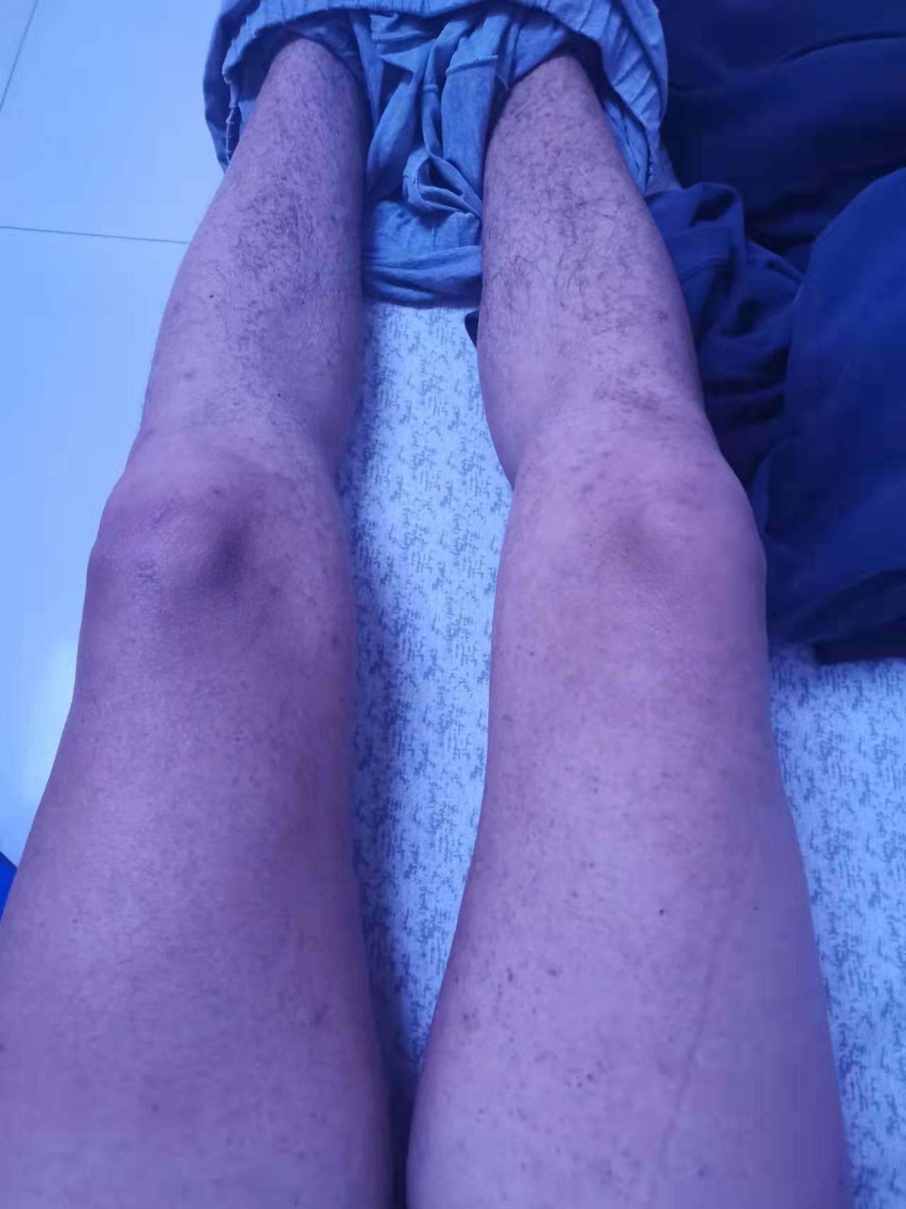 过敏性紫癜喝凉血祛风糖浆有效吗,为什么过敏性紫癜出血时间不延长