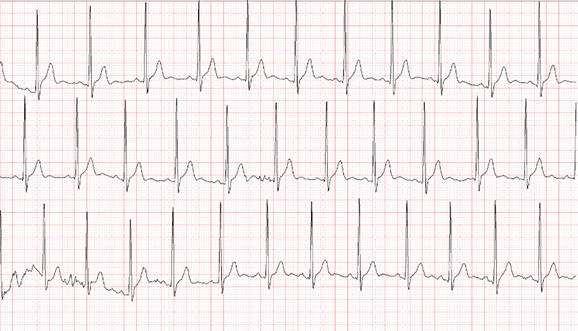 男子酒后胳膊疼，进院检查心电图没有异常，心内科主任：快抢救