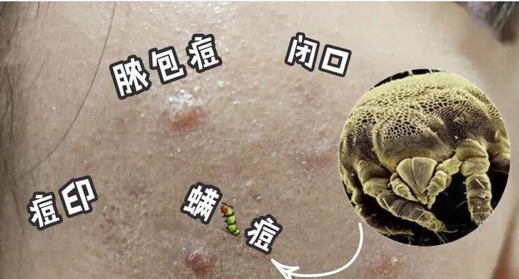 被子长期不晒“螨虫”扎堆？教你一招，不用晒不用洗，除螨又卫生