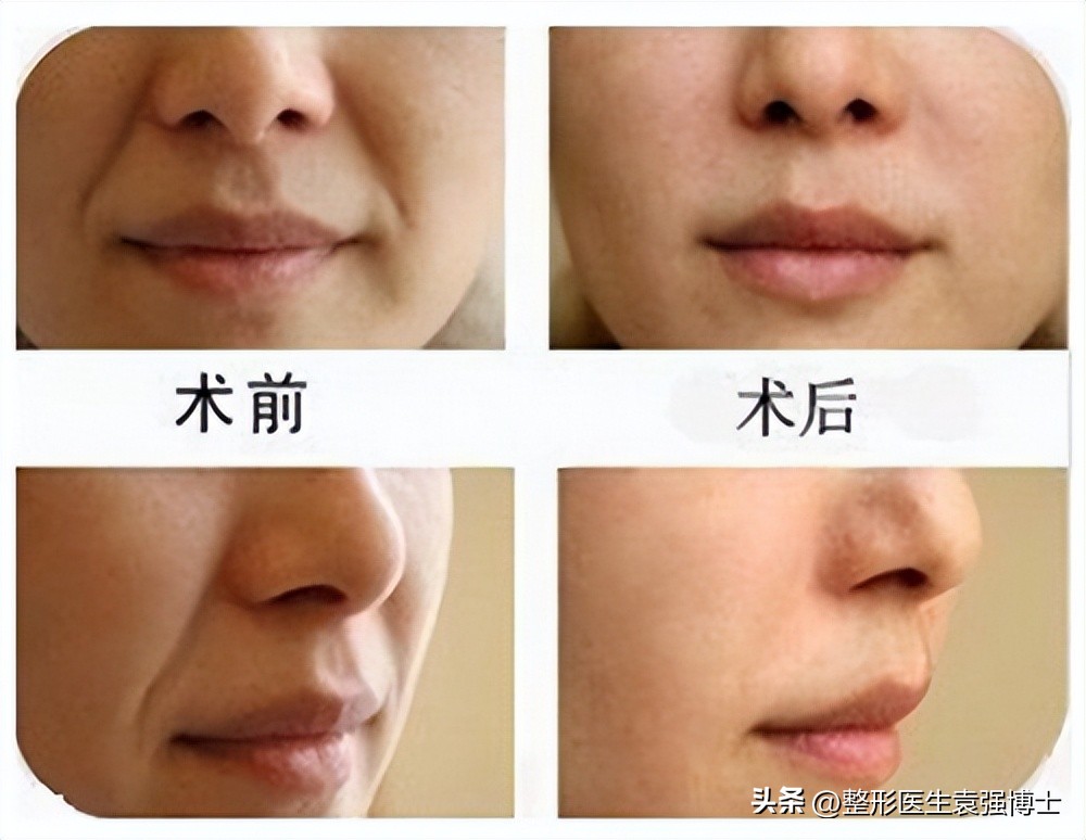 法令纹难去除，多是没弄清成因，医生教你几招实用的方法