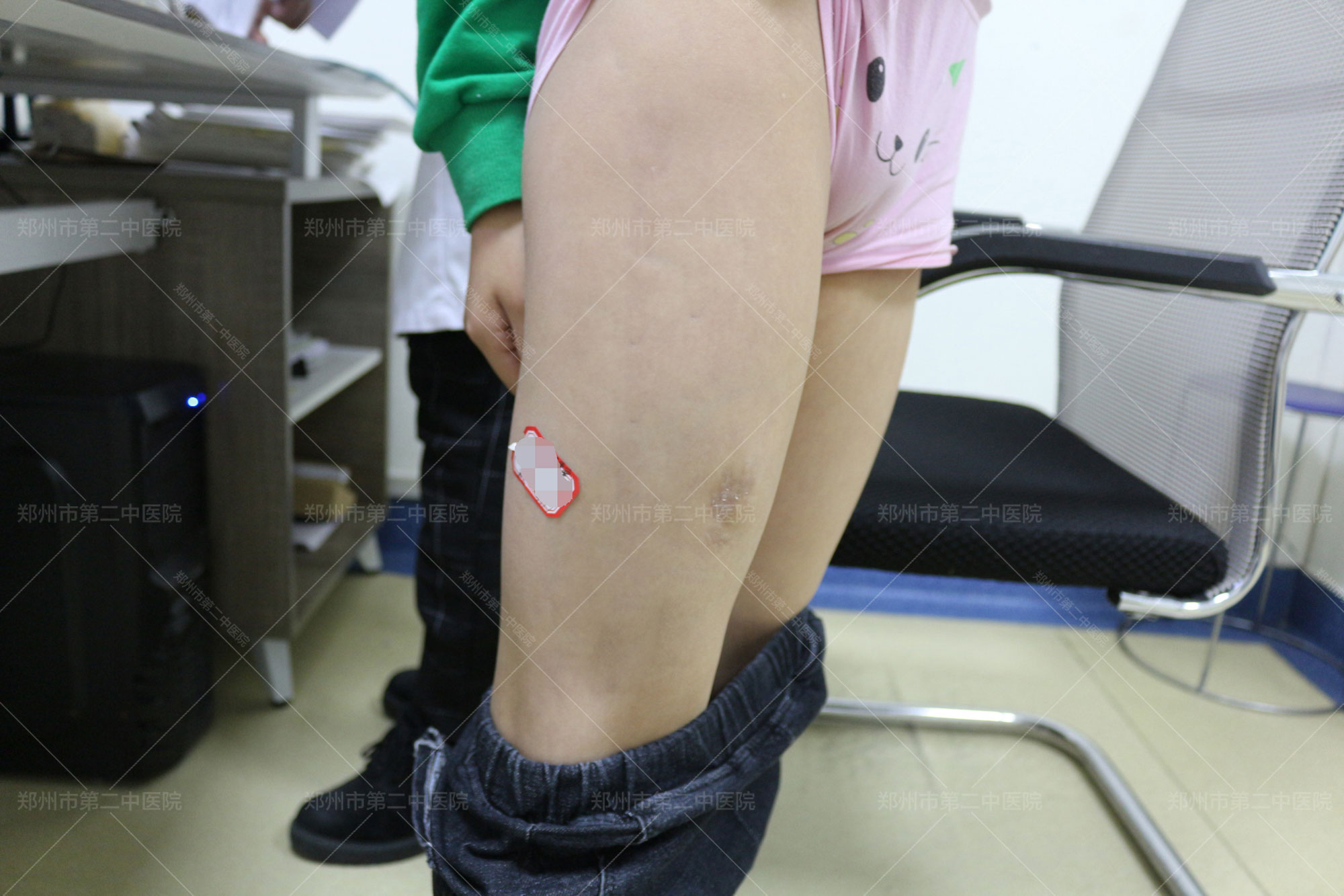 郑州哪个医院擅长治疤痕,郑州第二中医院怎么祛疤痕