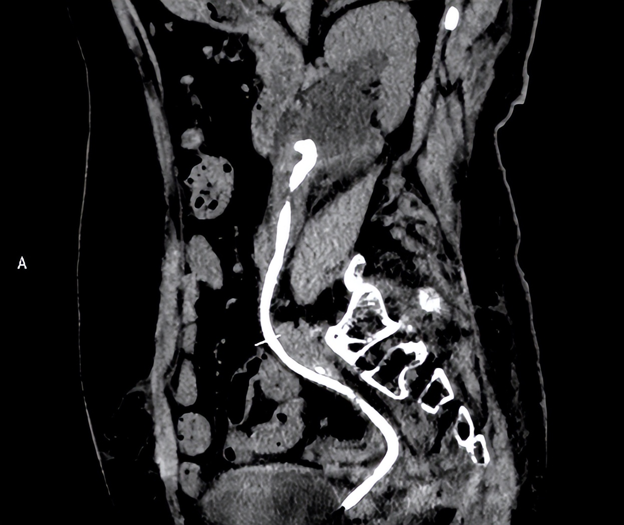 输尿管支架长满结石,输尿管支架管多久会附着结石