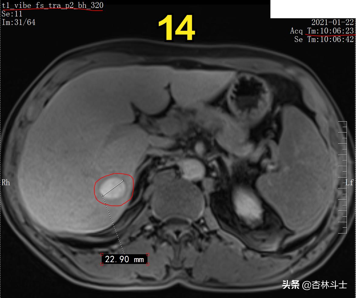 肝癌8公分肿瘤能活多久,肝癌细胞最大长多大