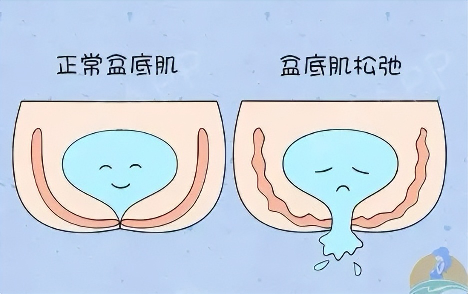 产后漏尿多长时间可以锻炼修复,产后漏尿怎么修复才好