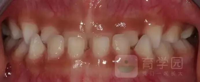 这几种小习惯正在毁掉宝宝的颜值,家长注意了这四种孩子会越来越丑