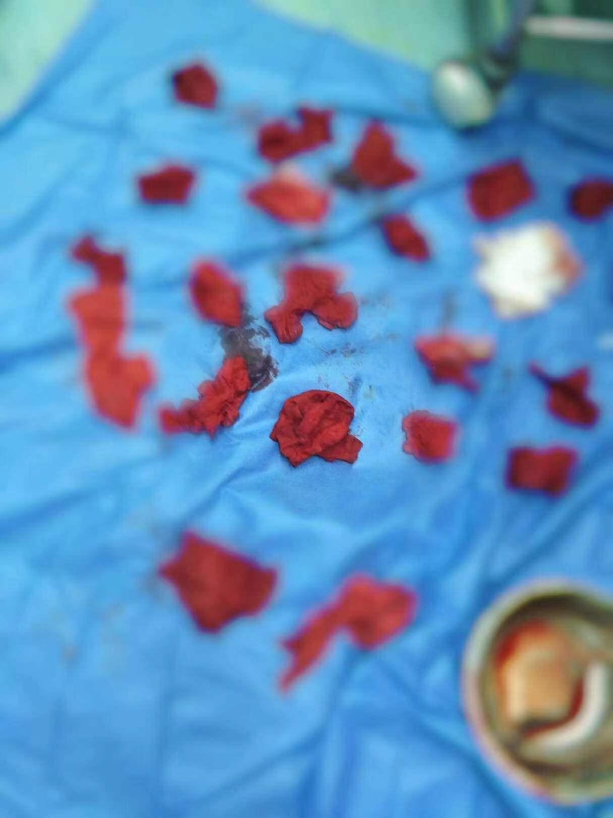 杭州21岁姑娘*夜初**大出血1500ml！无视生命安全，竟在手机找原因