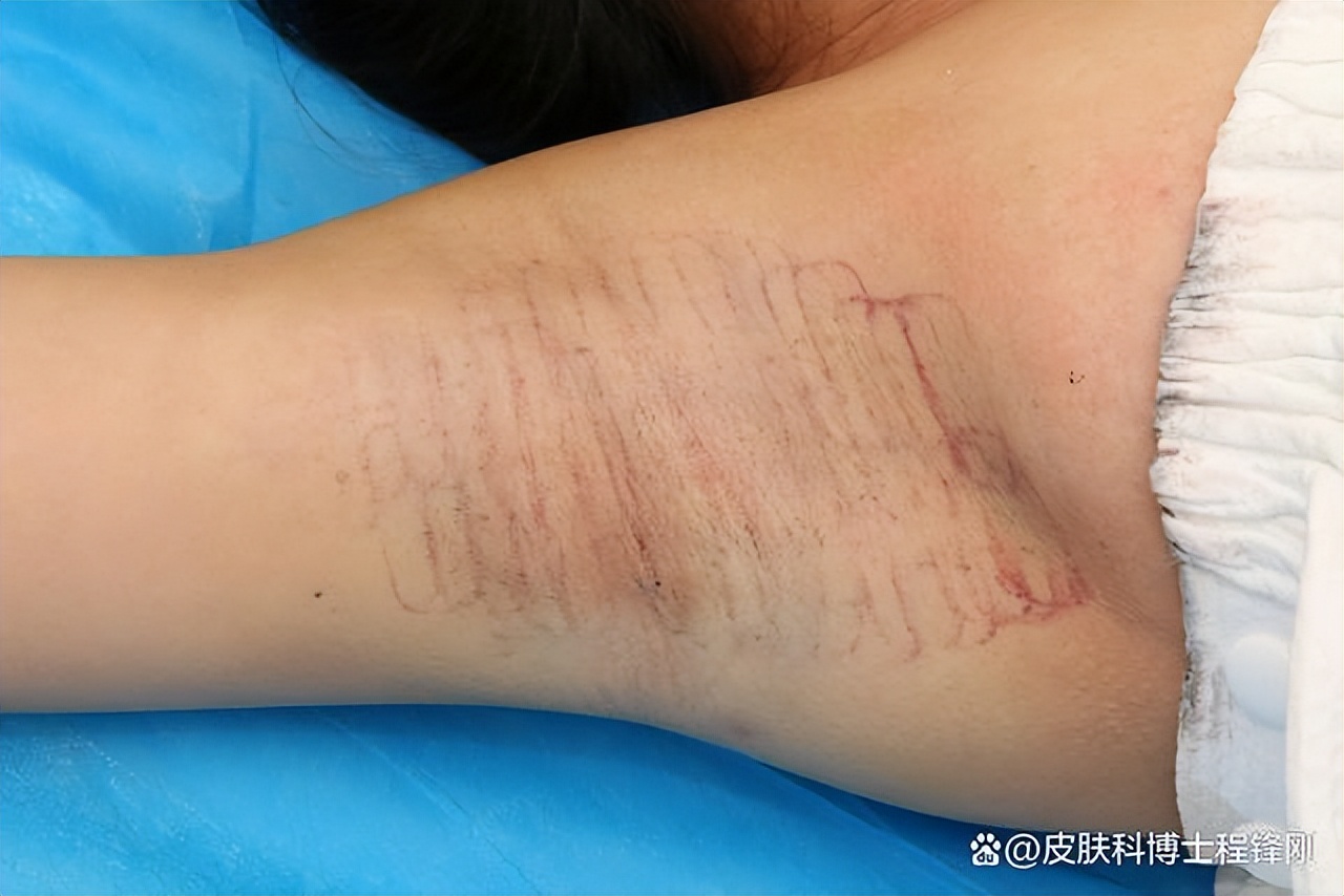 狐臭微创手术伤口流脓有臭味,狐臭微创3年后复发怎么办