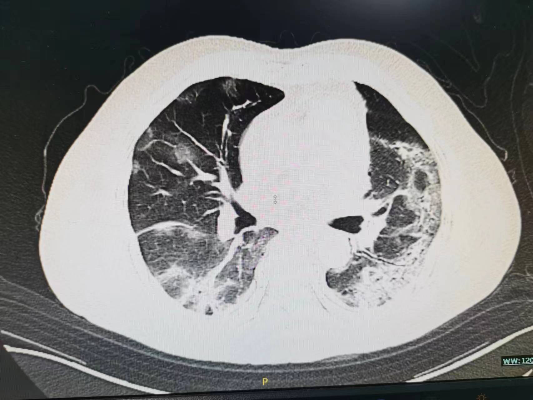 老年人总是低热是怎么回事,老年人一直低热都有什么原因