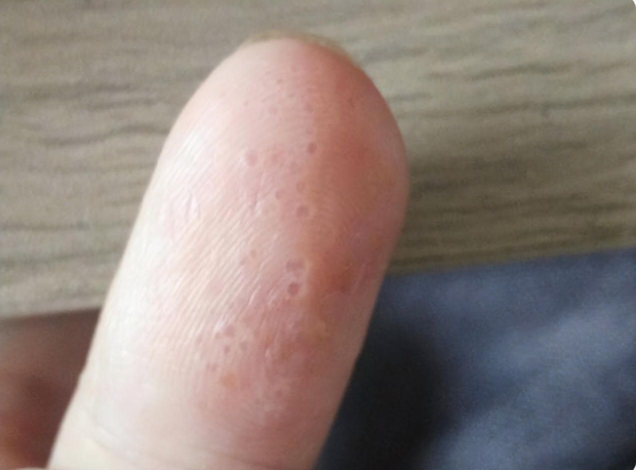 手上有脱皮小水泡很痒怎么办,孩子手上起小水泡脱皮痒