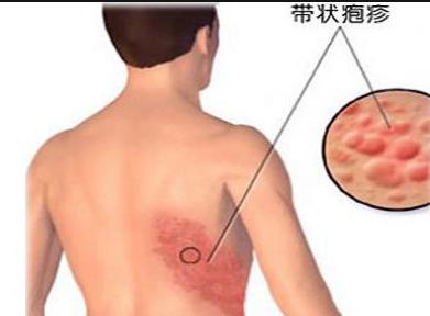 南京皮肤研究所能治好带状疱疹吗,治疗带状疱疹的奇方