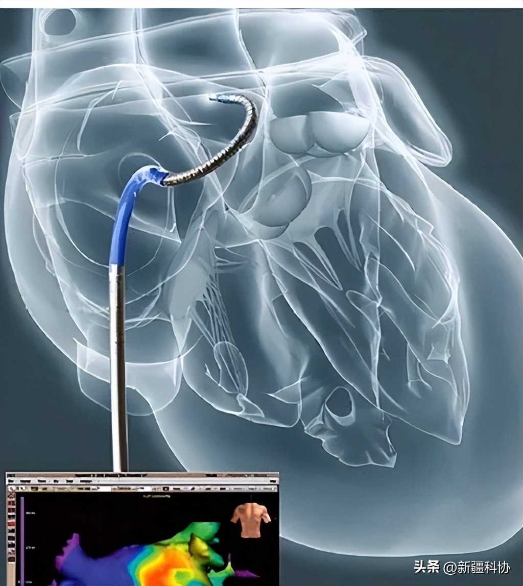 心律失常一定要采用射频消融吗,心律失常射频消融术哪里做得好