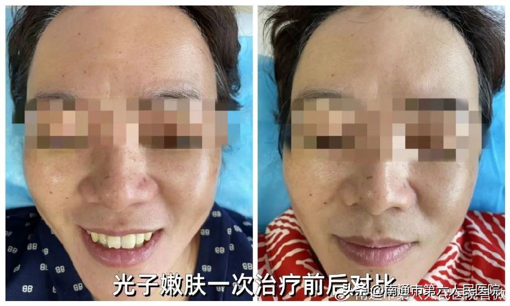 冰点脱毛除唇毛,冰点脱毛能根除体毛吗