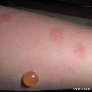 夏季被虫子咬了怎么办,夏季皮肤病攻略虫咬感染篇