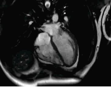 试管移植后多久会有胎心胎芽,试管移植后多久有胎心