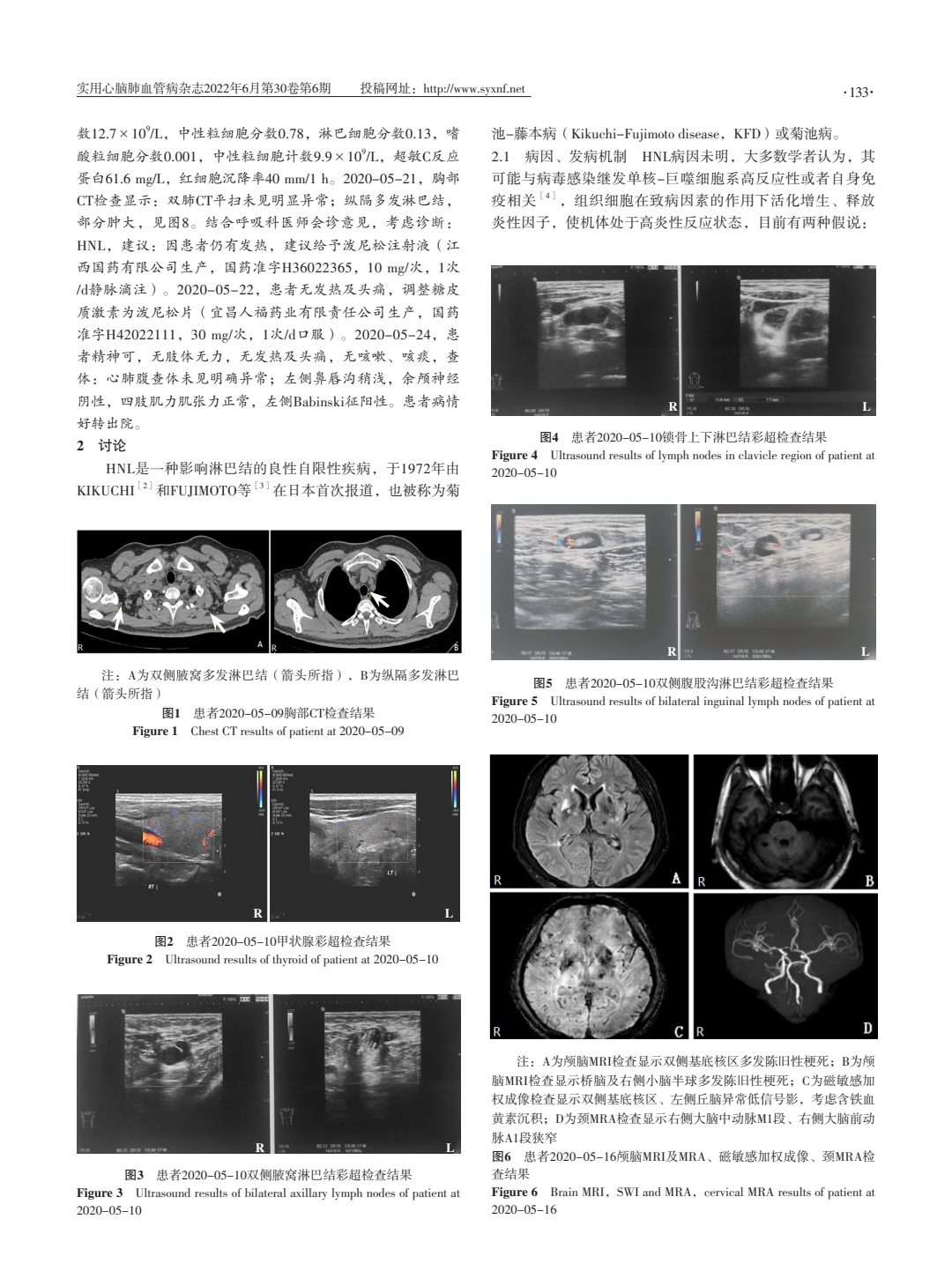 伴神经系统受损的组织细胞坏死性淋巴结炎一例报道并文献复习