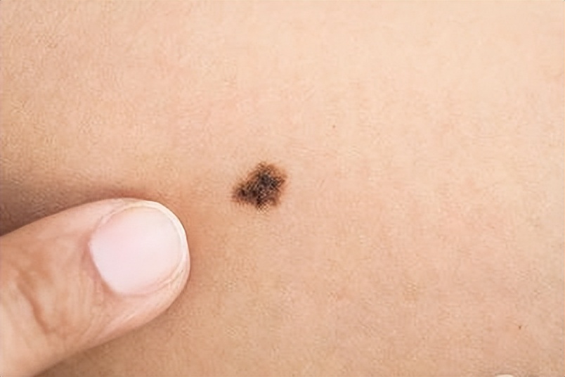 身上长红痣好还是长黑痣好,身上的痣出现这些变化小心会癌变