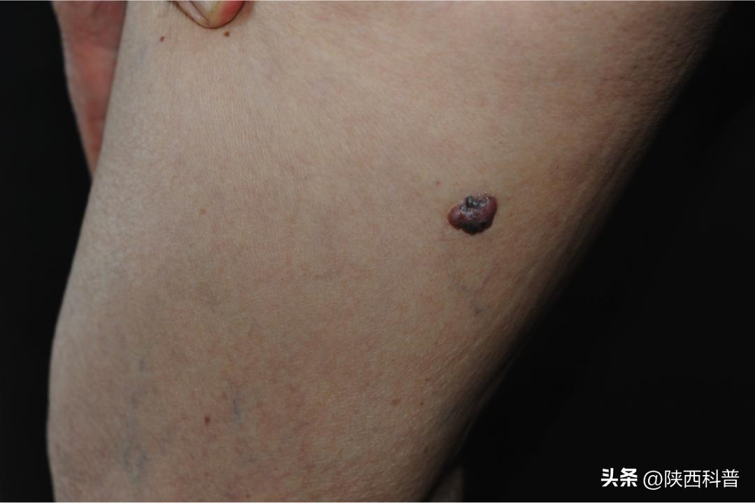 鼻子上的黑头的正确处理方法,鼻子上的黑头大家都是怎么解决的