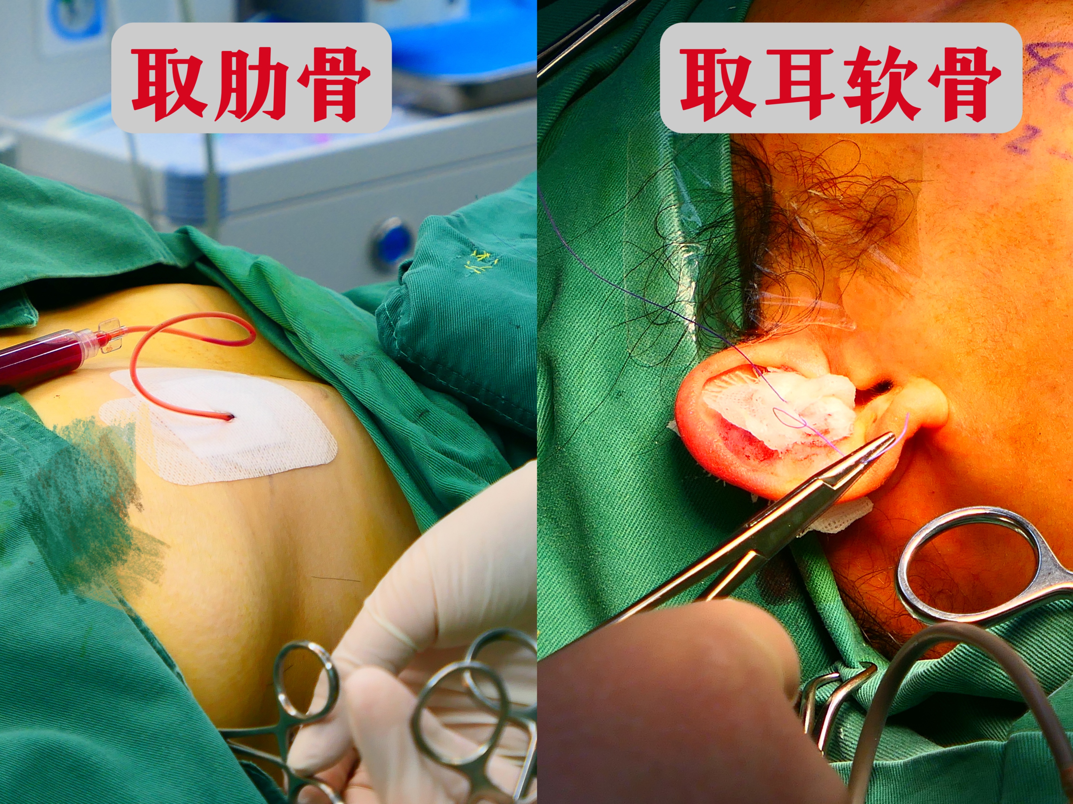 整形隆鼻手术,隆鼻整形全麻手术全过程