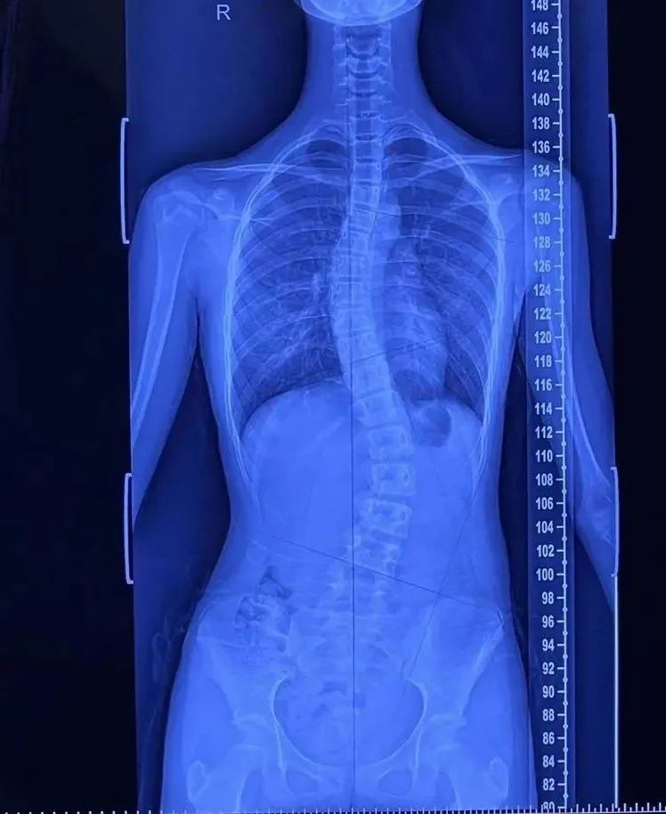 河北省儿童脊柱侧弯筛查,邢台市青少年脊柱侧弯筛查