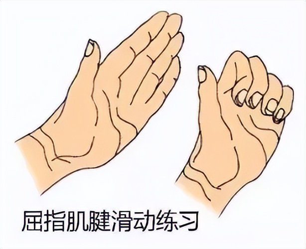 科普手指麻木背后的祸首鼠标手,鼠标手手指麻木康复训练动作