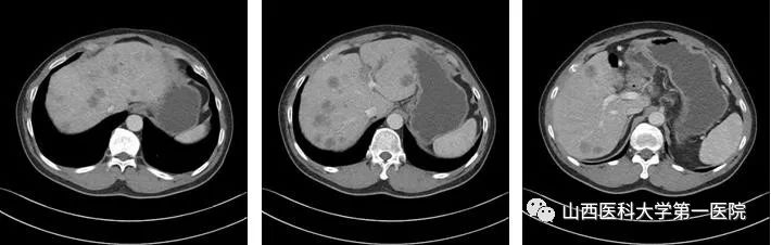 山西医科大学第一医院多学科凝心聚力攻克癌中之王再创新高