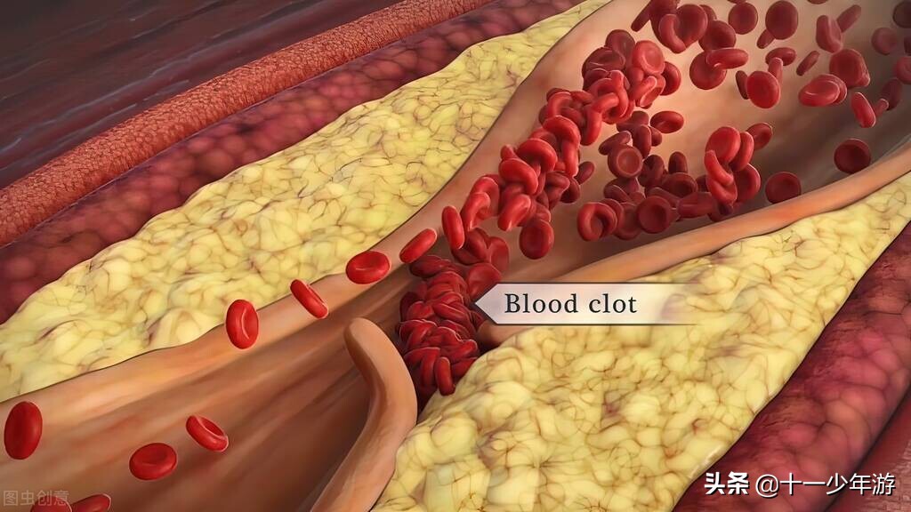 心源性脑栓塞治疗,心源性脑栓塞