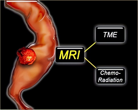 大肠癌科普知识,大肠癌最准确的筛查方法